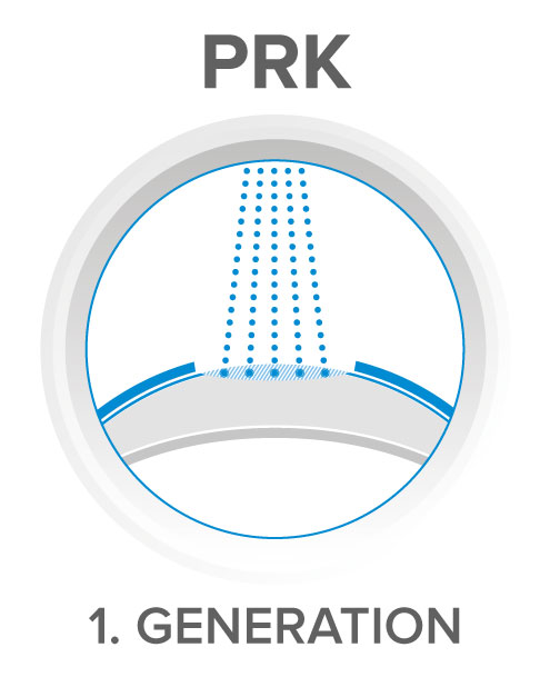 PRK - laser ad eccimeri