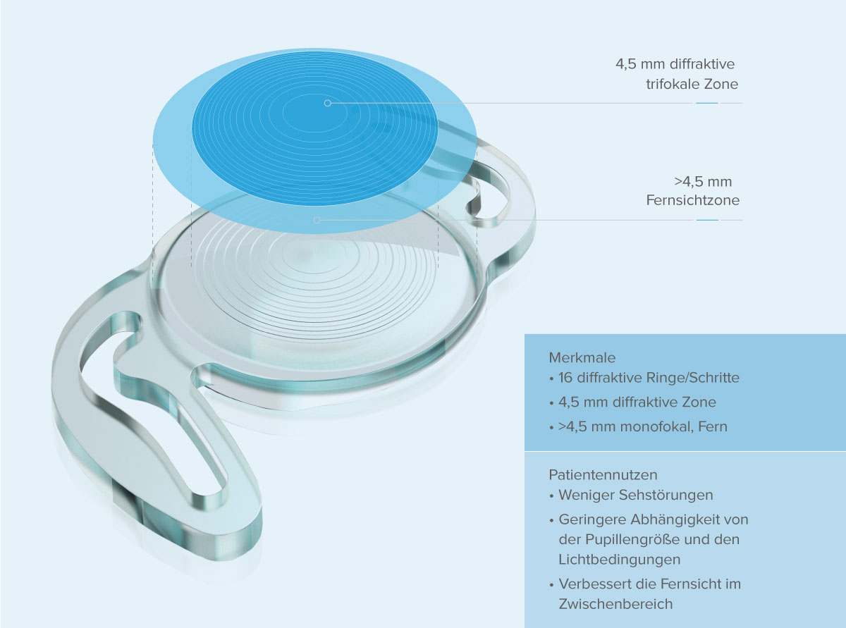 RayOne® Trifocal per la correzione della presbiopia