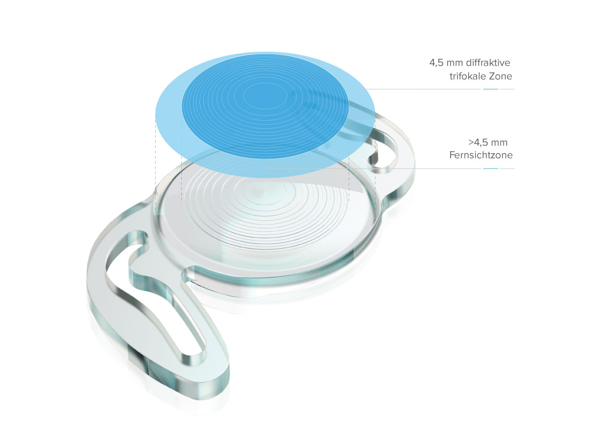 RayOne® Trifocal per la correzione della presbiopia