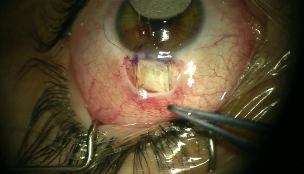 Suturazione dello sportello sclerale e della congiuntiva
