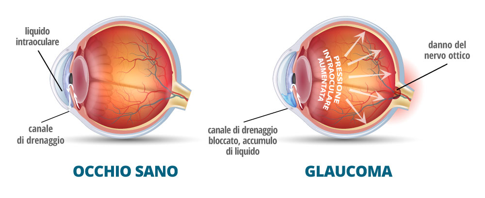 Glaucoma = stella verde