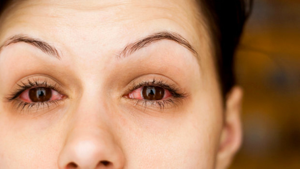 Occhi asciutti - Sindrome Sicca